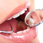 dental prophylaxis